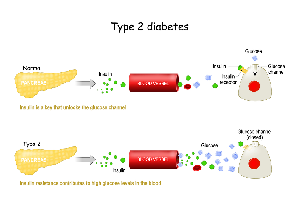 Type2 Diabeties Type2 Diabeties