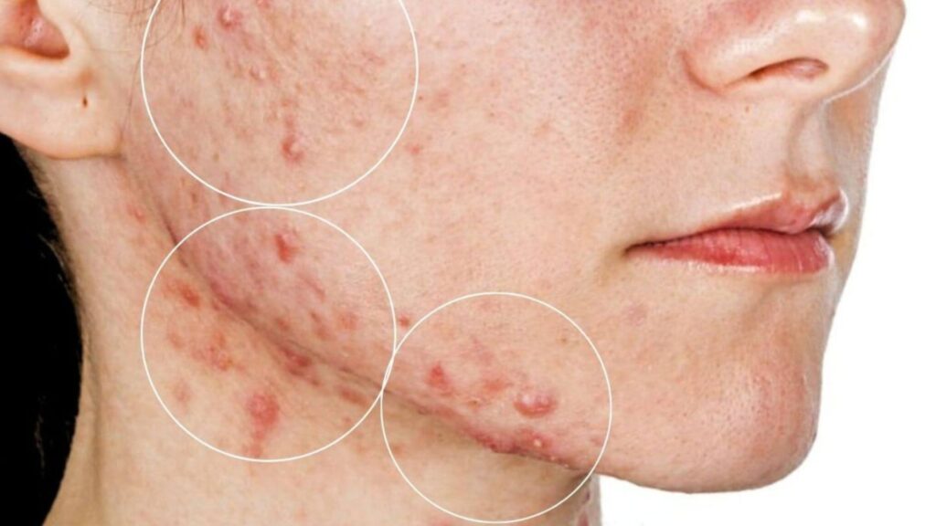 Home Remedies for Monsoon Acne Prevention Home Remedies for Monsoon Acne Prevention