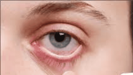 How Diabetes Can Damage Your Eyes: Precautions to Protect Your Vision