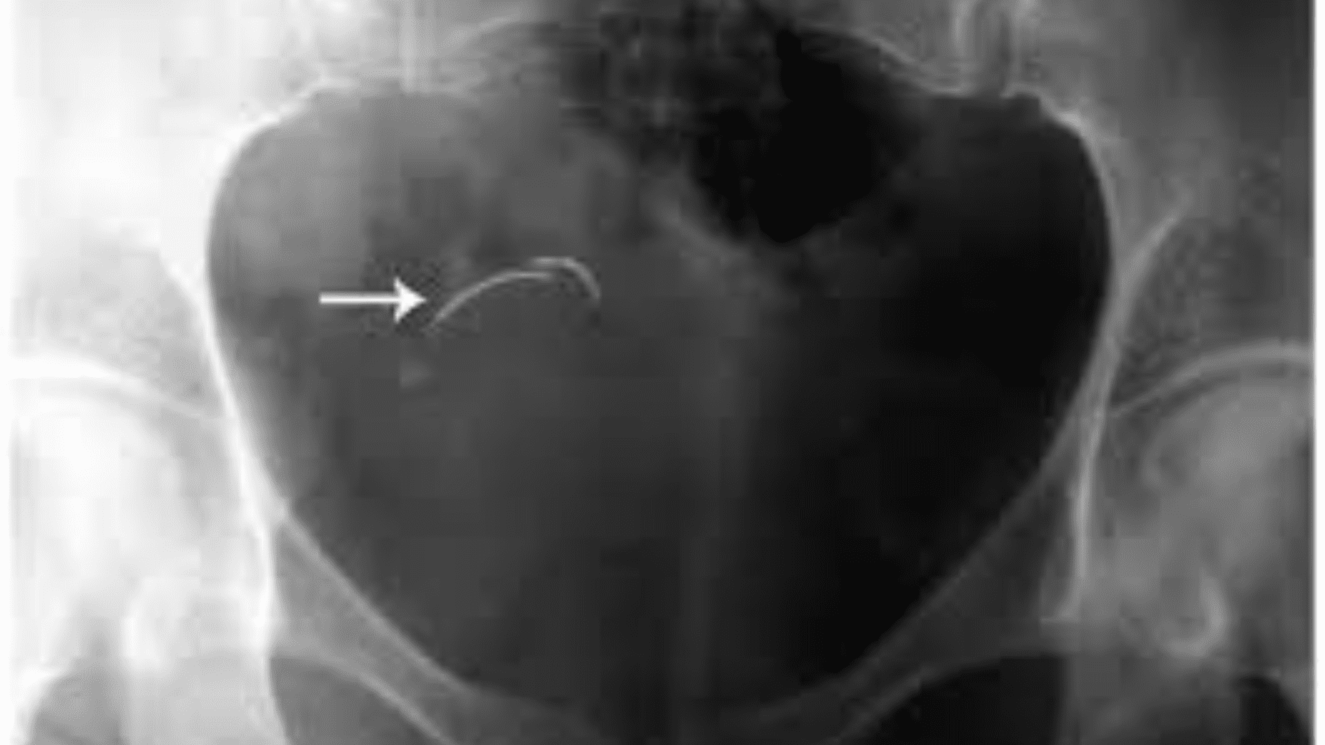 Needle Left Inside Women After Childbirth Finally Found After 18 Years: X-Ray Reveals