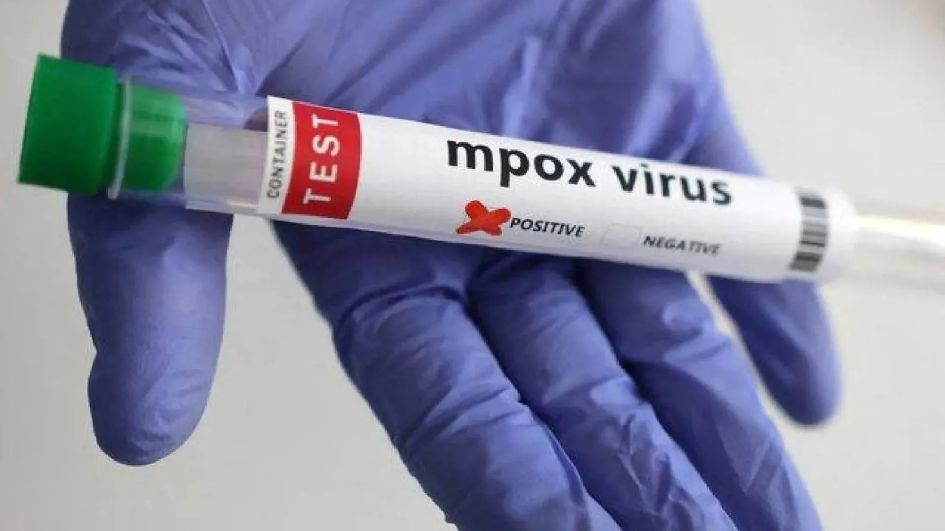 Azerbaijan Reports First Mpox Case, Patient Isolated in Baku