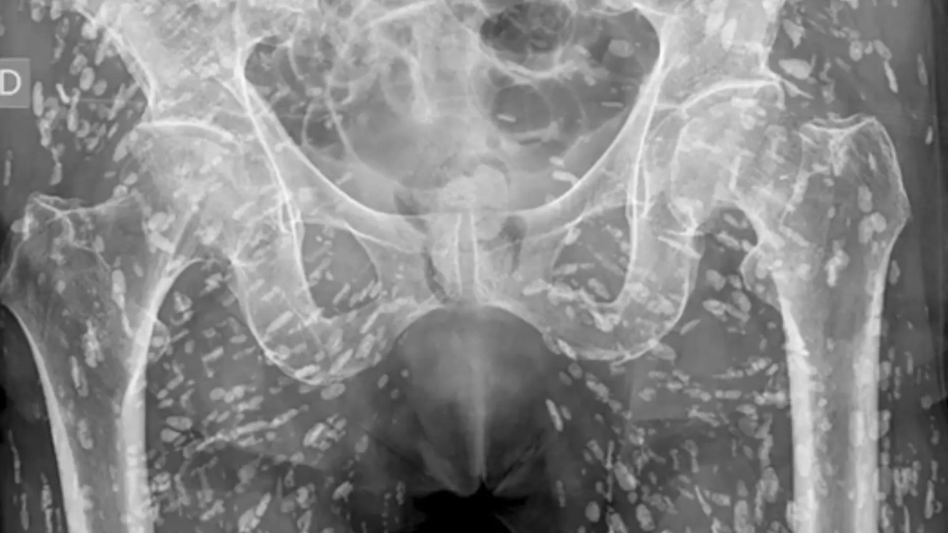 X-ray Reveals Shocking Tapeworm Larvae Infestation in Human Body
