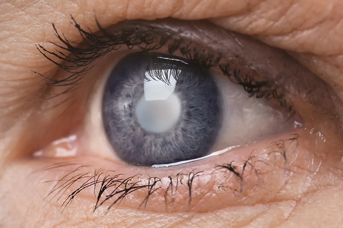 Glaucoma Awareness Month: Detect Early, Protect Your Sight!