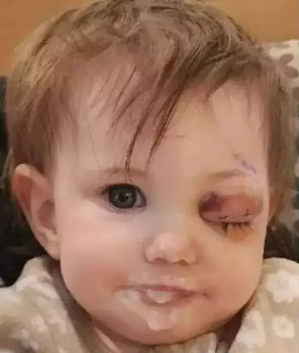 A Year-Old Girl Loses Eye to Rare Cancer: Symptoms Parents Must Not Ignore