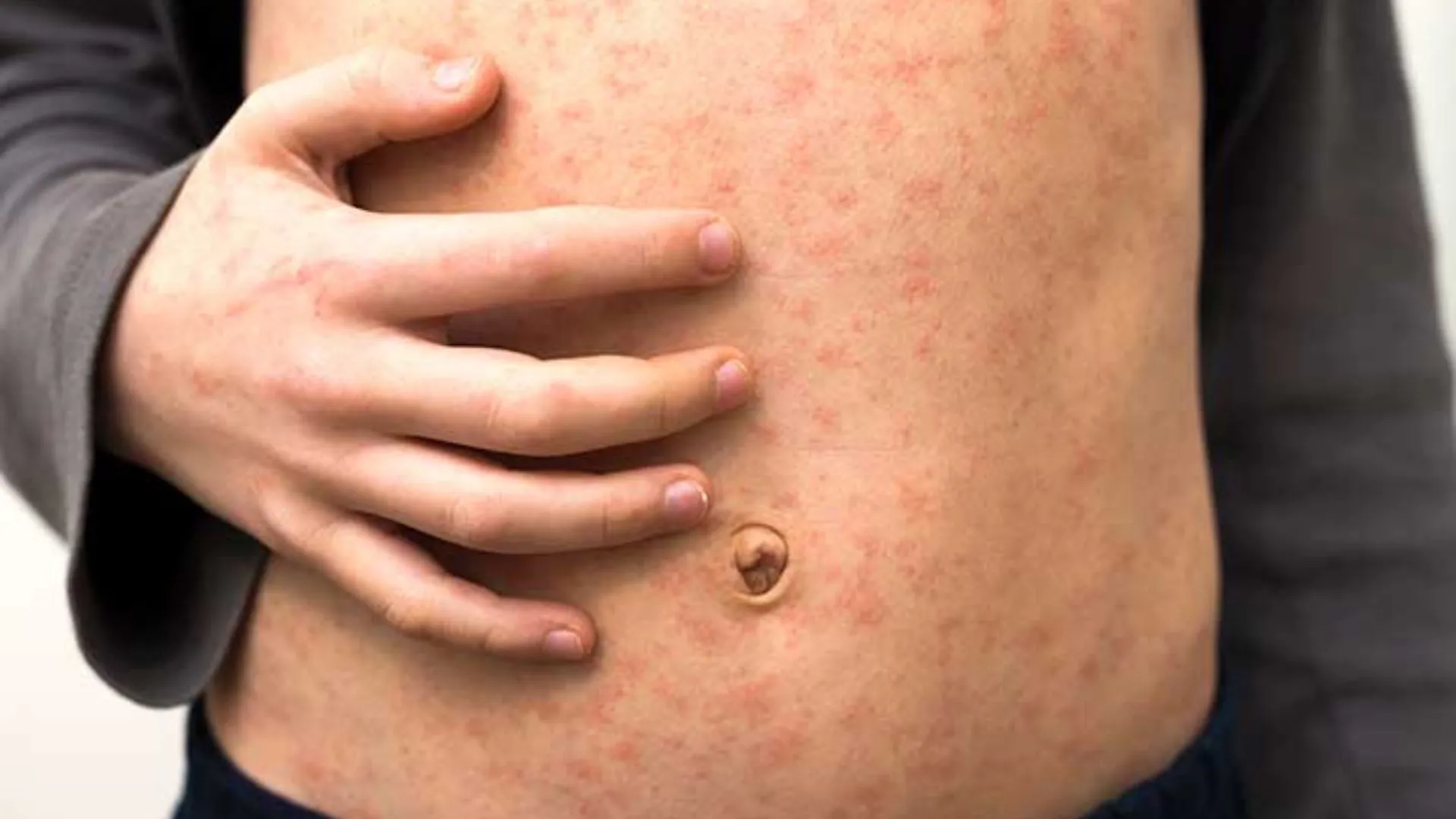 Worst Texas Measles Outbreak in 30 Years Escalates to 48 Cases