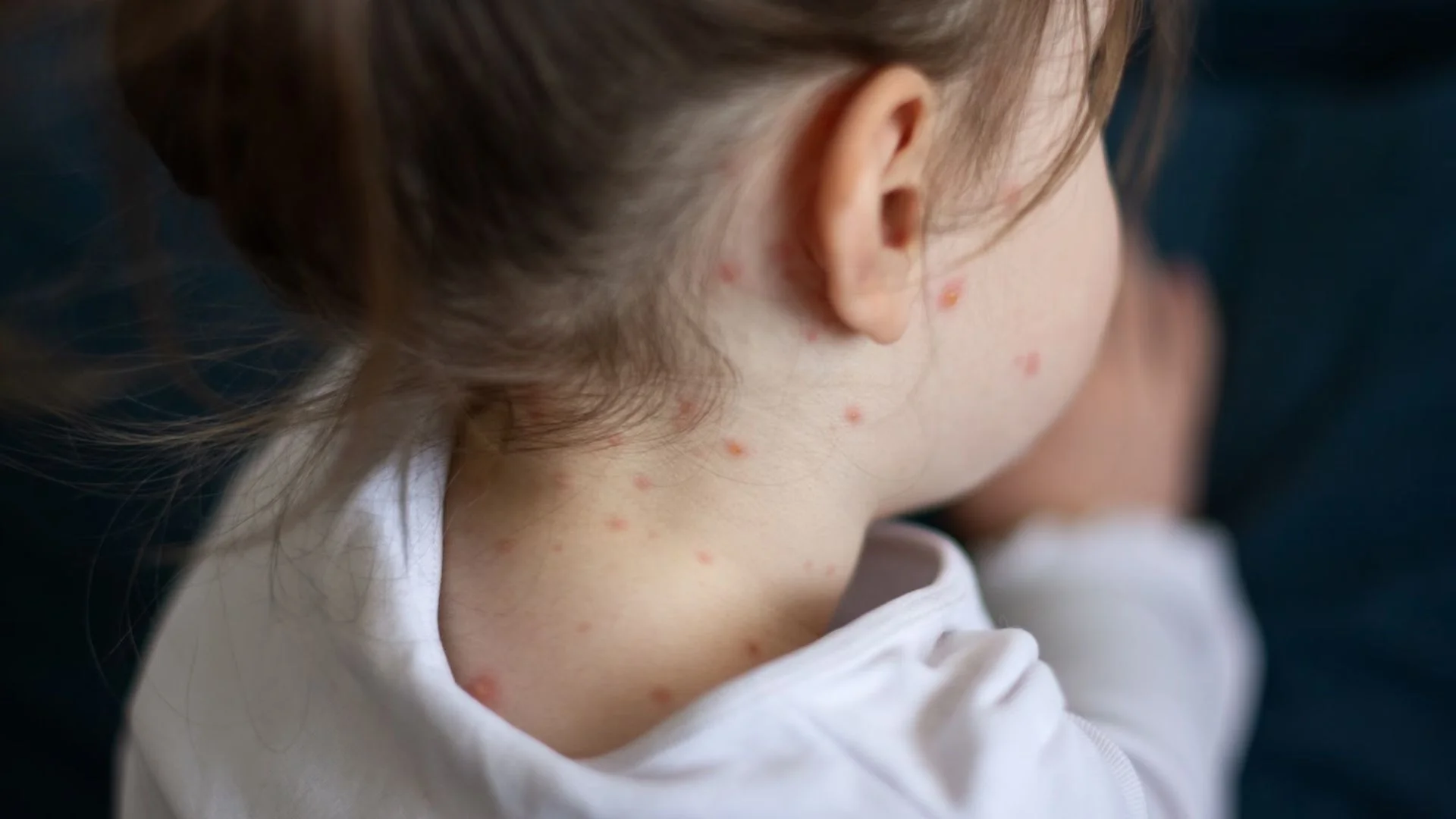 Texas Child Dies From Measles As Outbreak Spreads, Experts Blame Falling Vaccination Rates