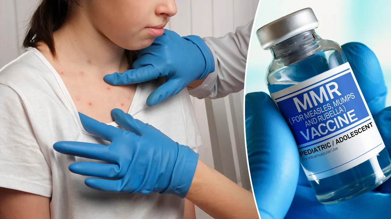 Texas Measles Surge: 48 Cases, Worst in 30 Years
