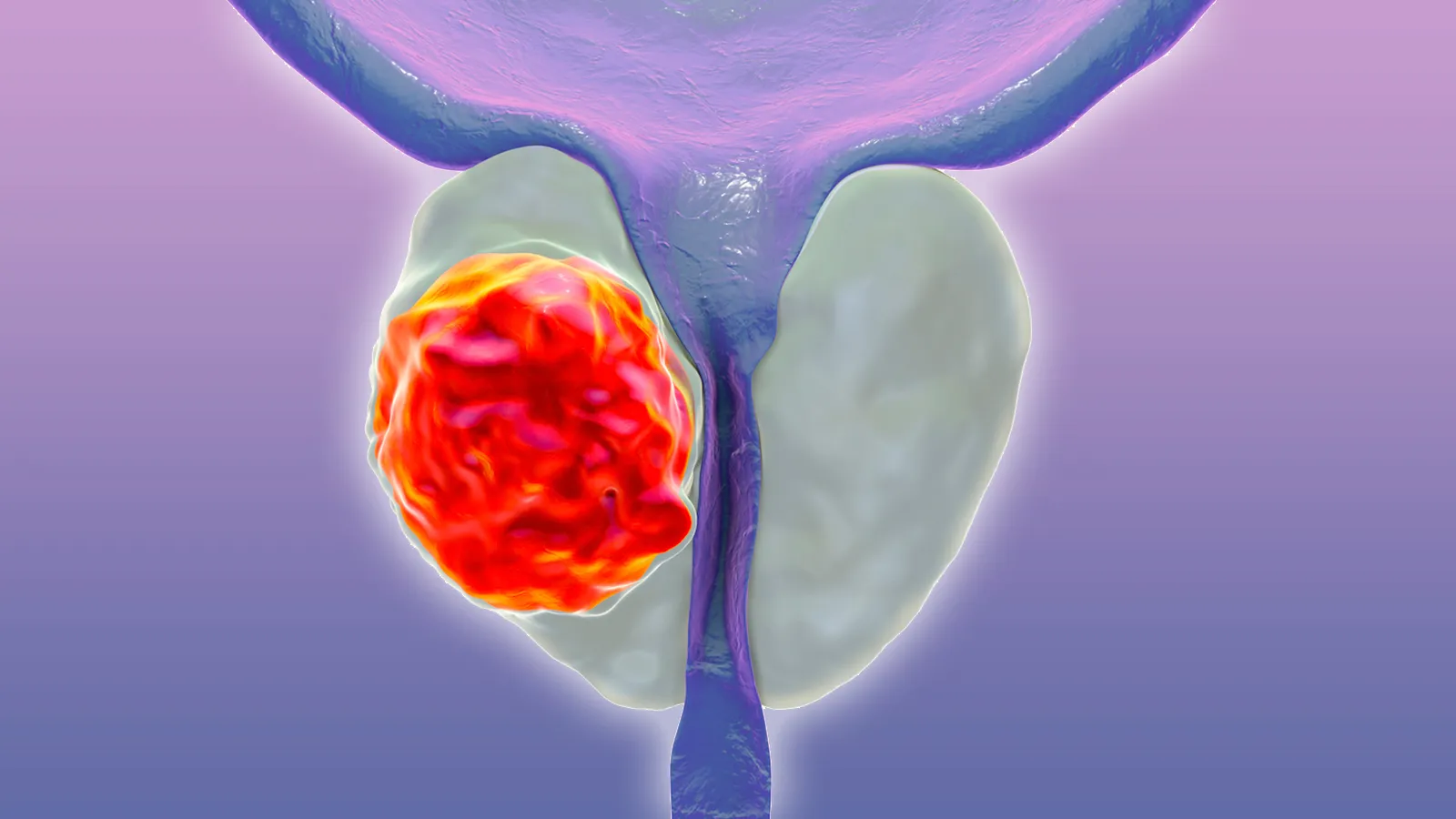 California Sees Alarming Rise in Aggressive Prostate Cancer Cases