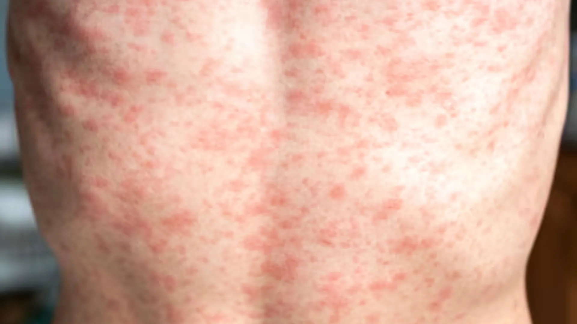 Measles Outbreak: How Bad Is It And How To Stay Protected? | TDG Explainer