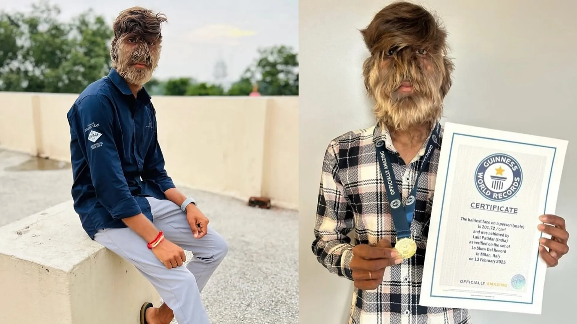 Indian Teen with ‘Werewolf Syndrome’ Sets Guinness World Record for Hairiest Face