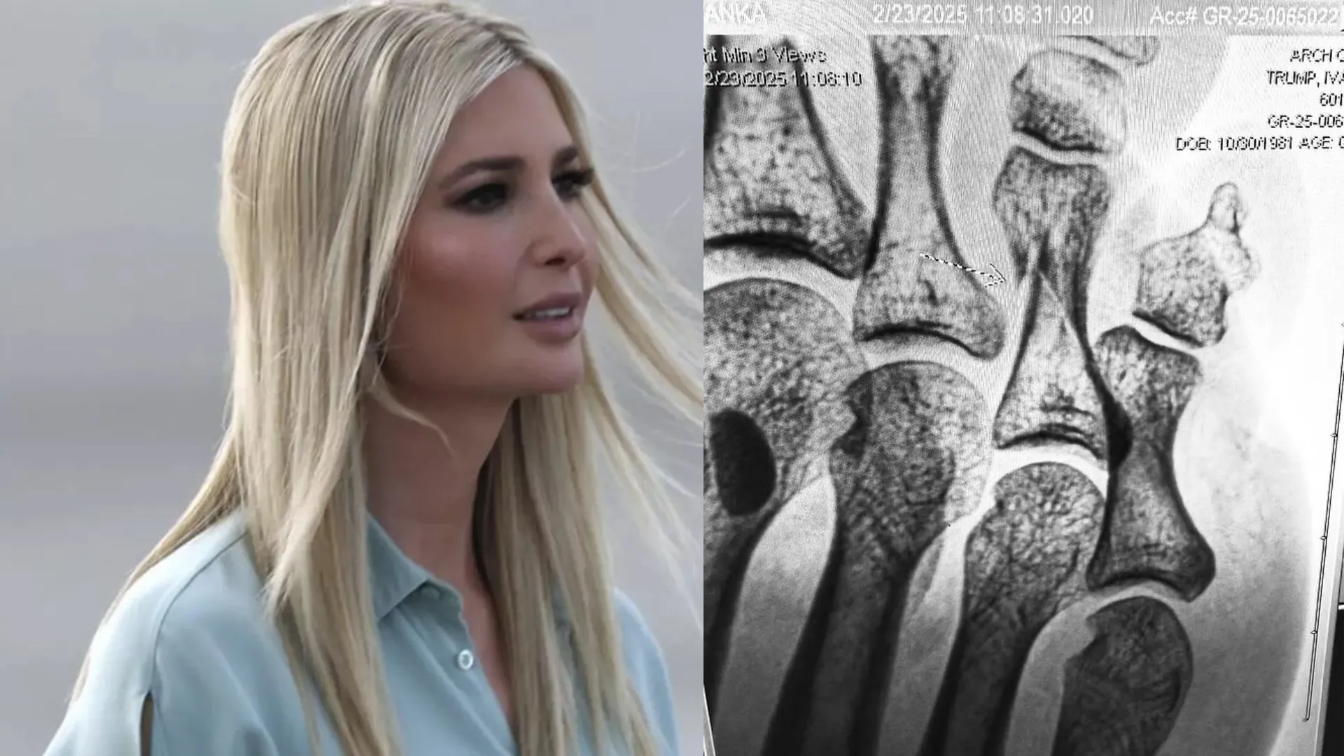 Ivanka Trump’s Mystery Injury: X-ray Post Leaves Fans Worried