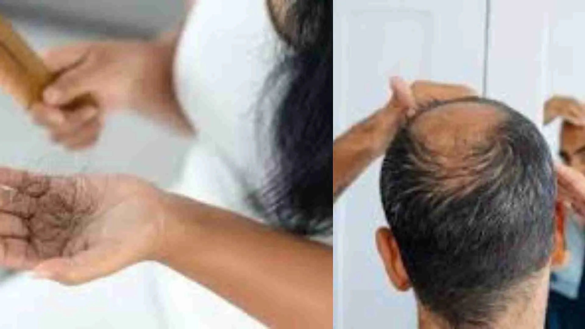 This 1990s Drug Is The Secret For Treating Your Hair Regrowth: A Game Changer