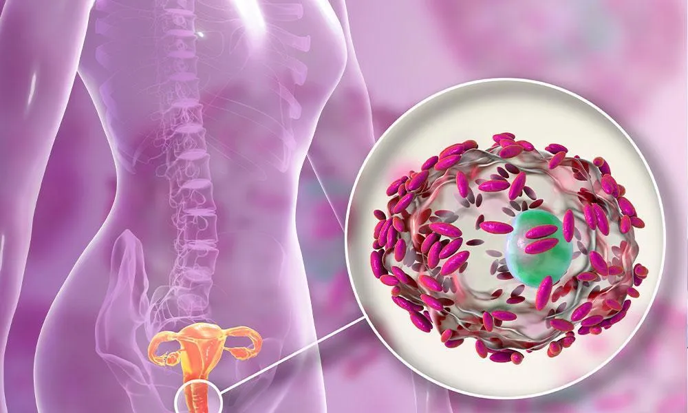 Bacterial Vaginosis Passed by Men: New Study Insights