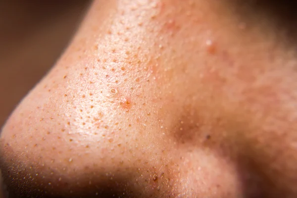 From Strawberry Nose to Flat-Cake: The Food-Inspired World of Medical Conditions