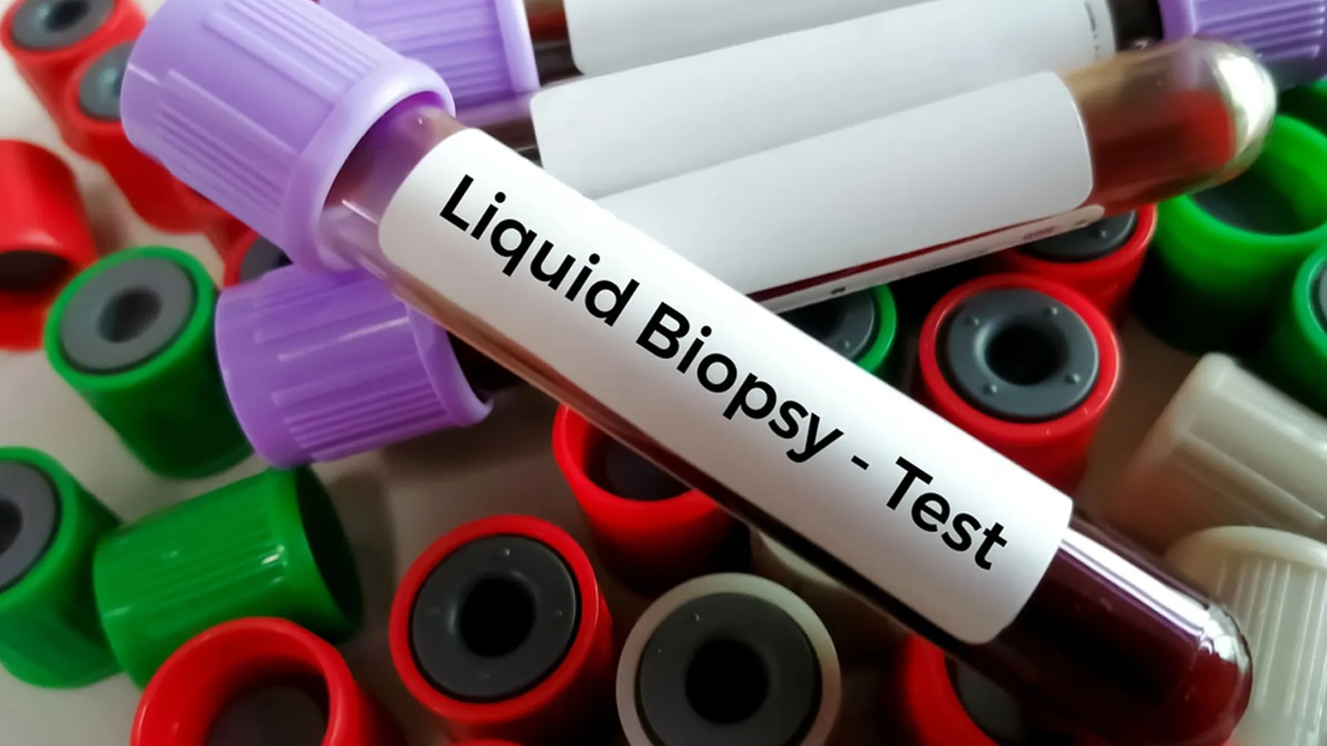 Cancer Screening Revolution: Liquid Biopsy Offers Hope for Early, Painless Detection