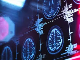 Rare Brain Disease Causes Sponge-Like Holes: 3 Mysterious Cases in Oregon
