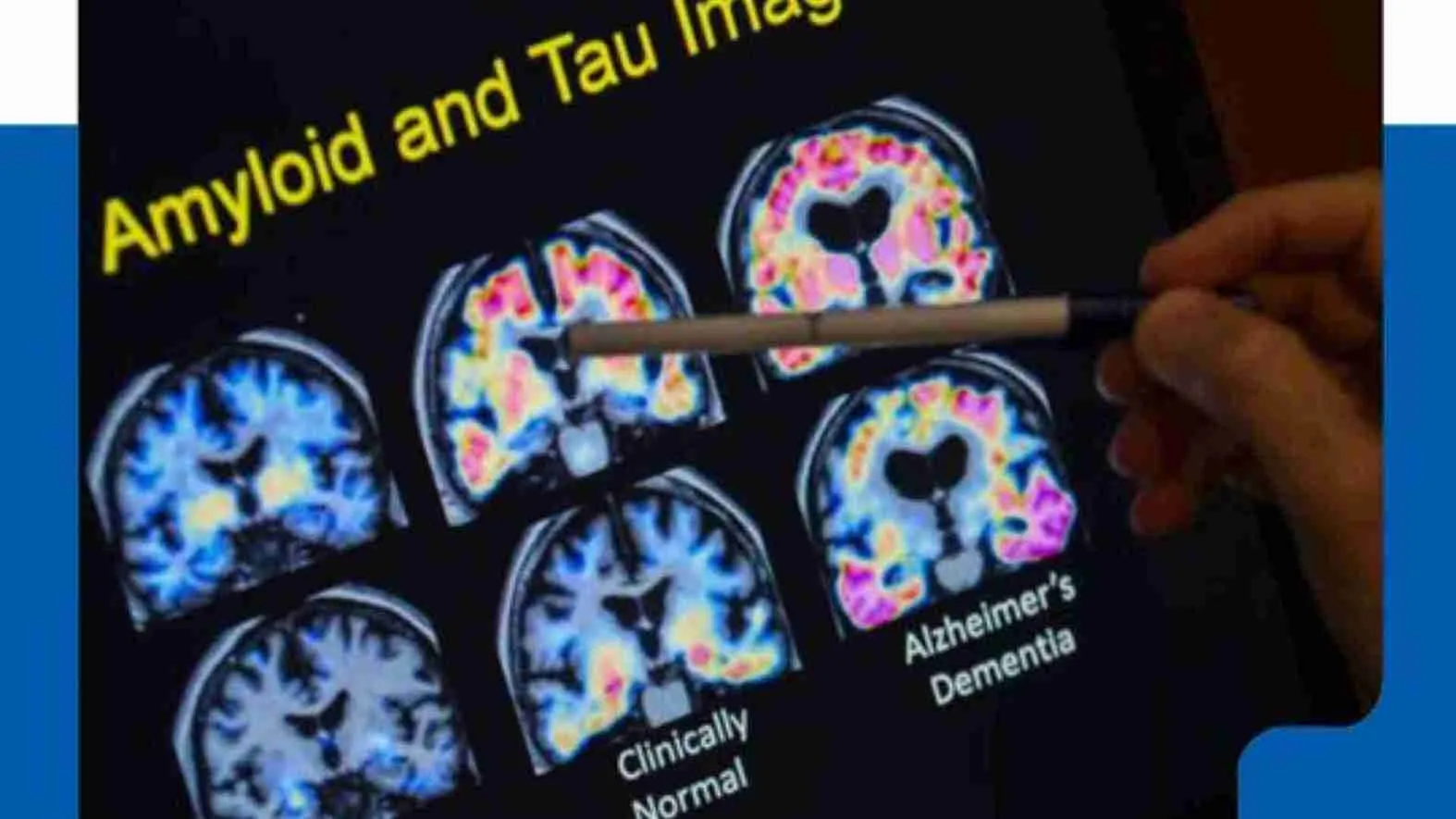 FDA Approves Revolutionary Blood Test To Detect Alzheimer’s Early In US