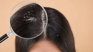 Dandruff or Fungal Infection? Here’s How to Tell the Difference, According to a Doctor